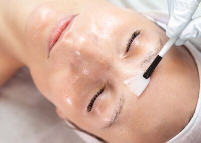 Chemical Peel
