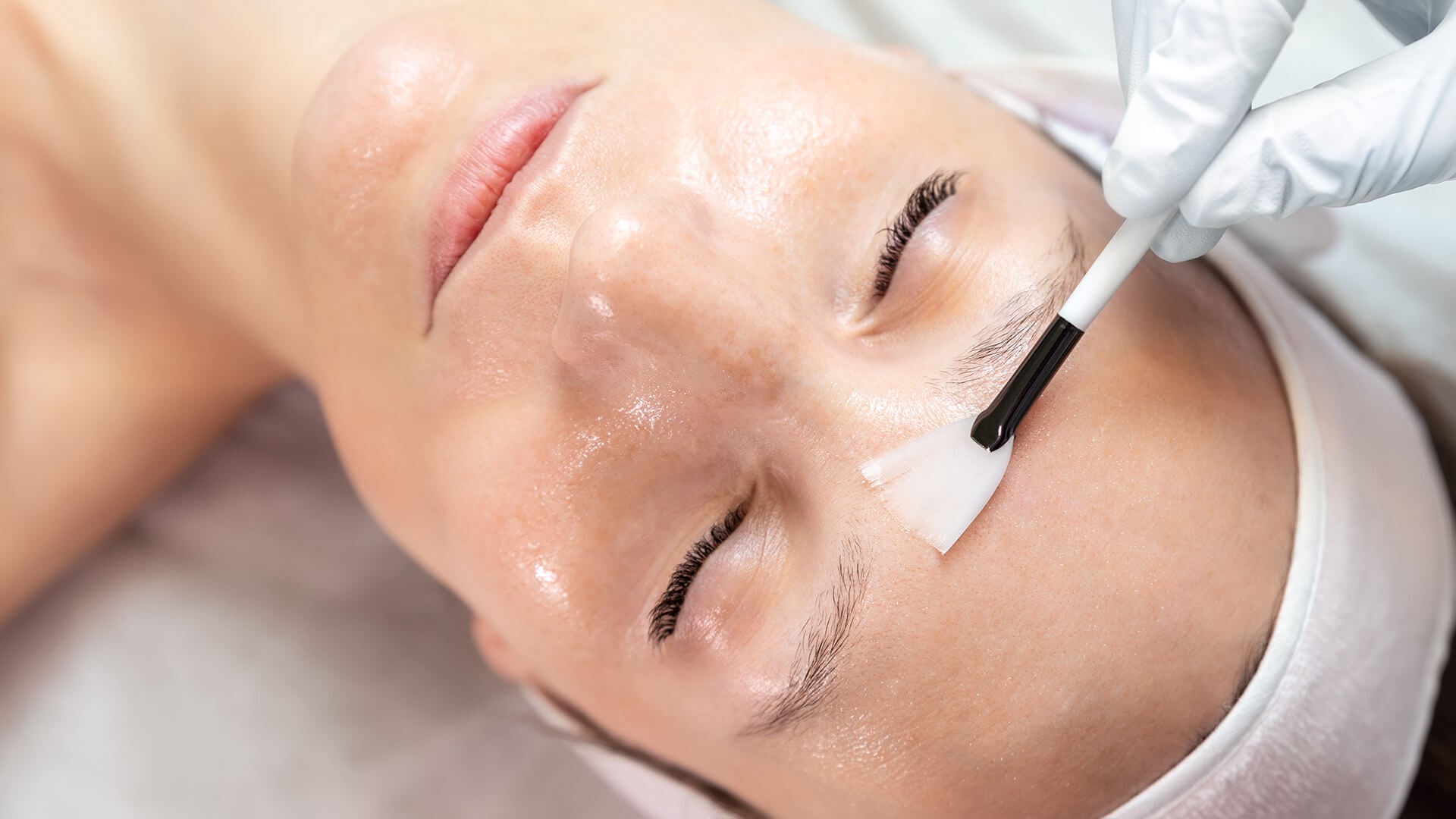 Chemical Peel Chemical Peel