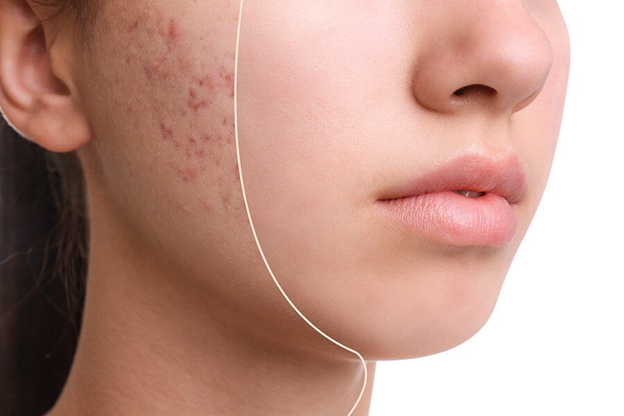 Acne Treatment Facial Acne Treatment Facial
